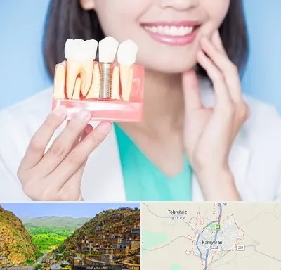 متخصص ایمپلنت در کامیاران