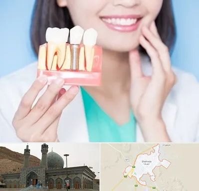 متخصص ایمپلنت در شهرضا