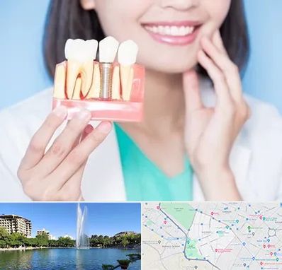 متخصص ایمپلنت در کوهسنگی مشهد