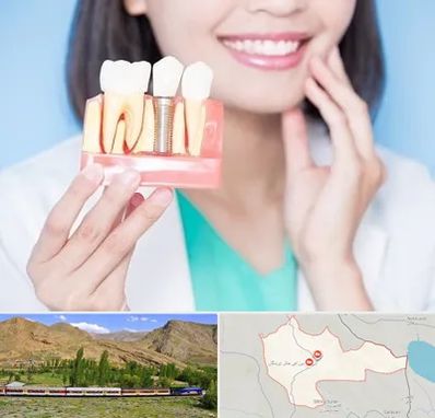 متخصص ایمپلنت در خاش