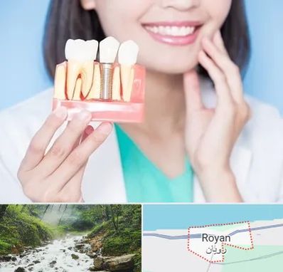 متخصص ایمپلنت در رویان