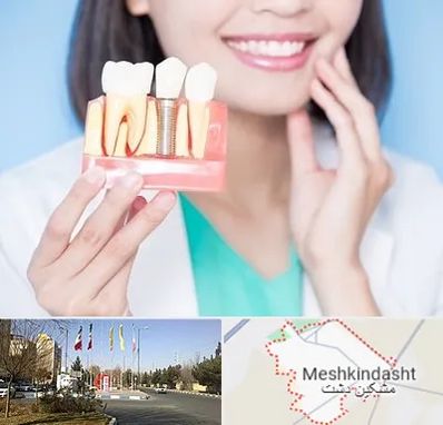 متخصص ایمپلنت در مشکین دشت
