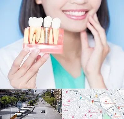 متخصص ایمپلنت در خیابان زند شیراز