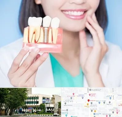 متخصص ایمپلنت در طالقانی