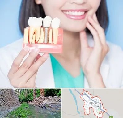 متخصص ایمپلنت در سراوان