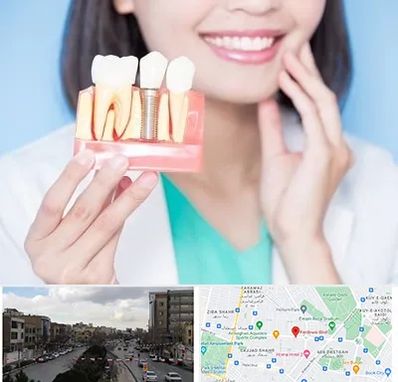 متخصص ایمپلنت در بلوار فردوسی مشهد