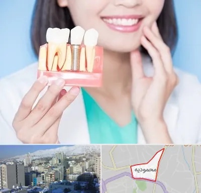 متخصص ایمپلنت در محمودیه