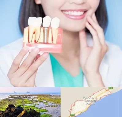 متخصص ایمپلنت در بندرلنگه