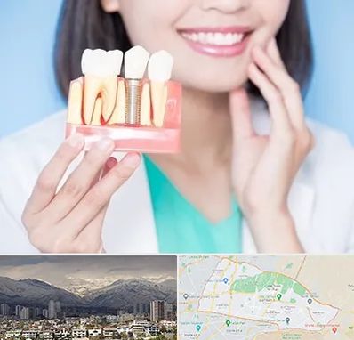 متخصص ایمپلنت در منطقه 4 تهران