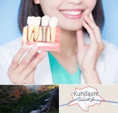متخصص ایمپلنت در کوهدشت