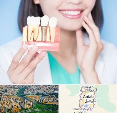 متخصص ایمپلنت در اردبیل