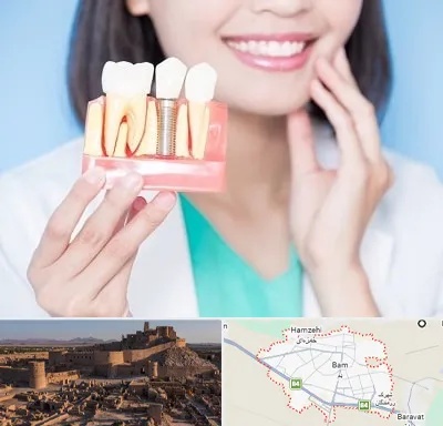 متخصص ایمپلنت در بم