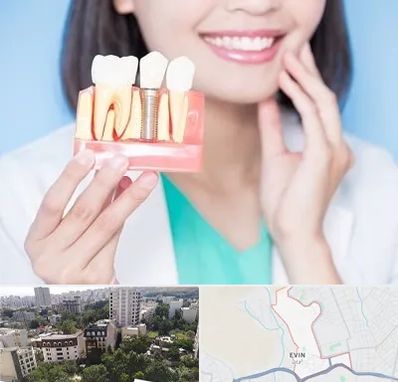 متخصص ایمپلنت در اوین