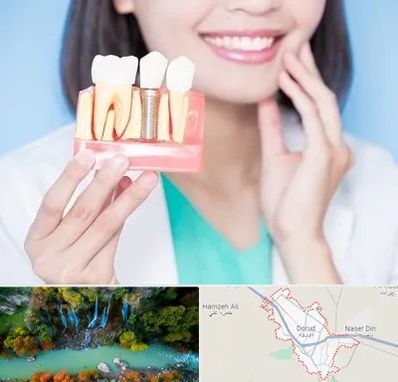 متخصص ایمپلنت در دورود