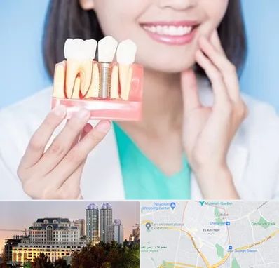 متخصص ایمپلنت در فرشته