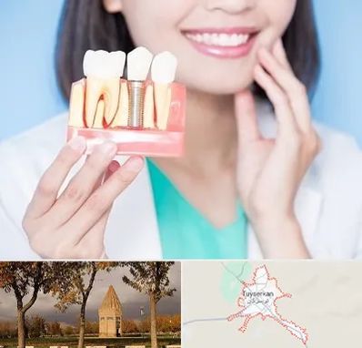 متخصص ایمپلنت در تویسرکان