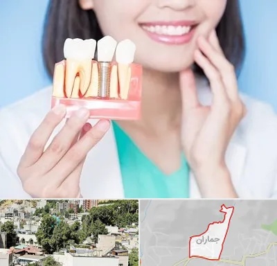 متخصص ایمپلنت در جماران
