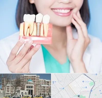 متخصص ایمپلنت در طلاب مشهد