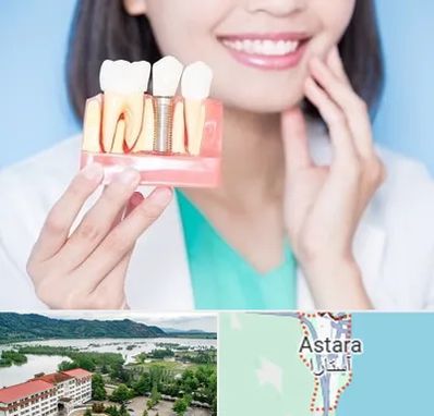 متخصص ایمپلنت در آستارا