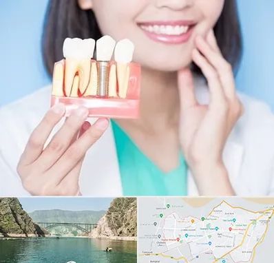 متخصص ایمپلنت در ایلام