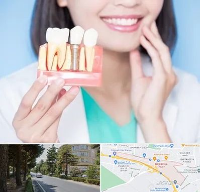 متخصص ایمپلنت در مهرویلا کرج