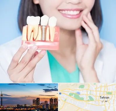 متخصص ایمپلنت در غرب تهران