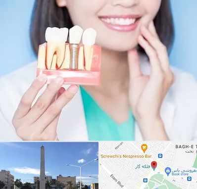 متخصص ایمپلنت در فلکه گاز شیراز