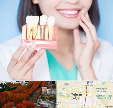 متخصص ایمپلنت در ولیعصر