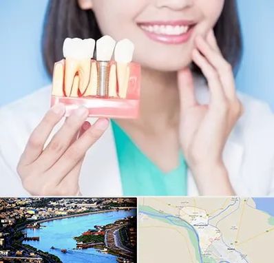 متخصص ایمپلنت در خرمشهر