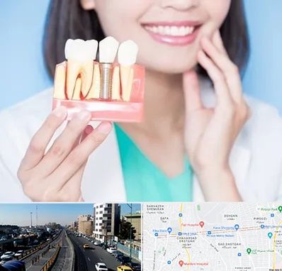 متخصص ایمپلنت در پیروزی