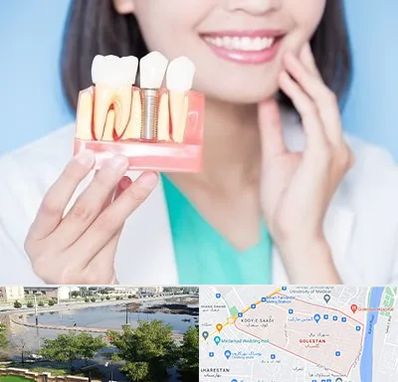 متخصص ایمپلنت در گلستان اهواز