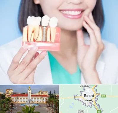 متخصص ایمپلنت در رشت