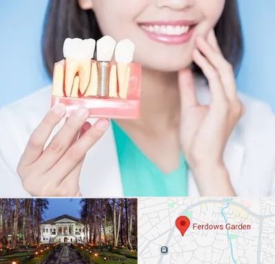 متخصص ایمپلنت در باغ فردوس