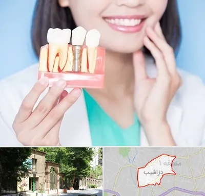متخصص ایمپلنت در دزاشیب