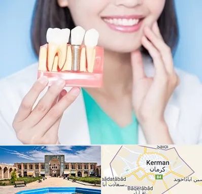 متخصص ایمپلنت در کرمان