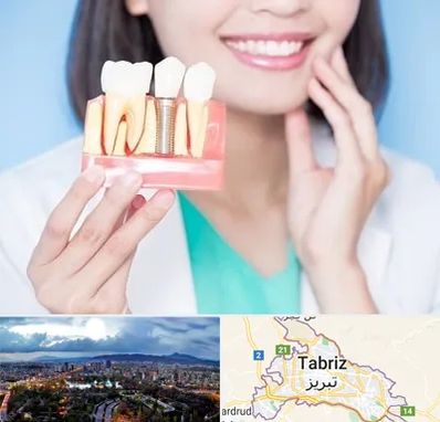 متخصص ایمپلنت در تبریز