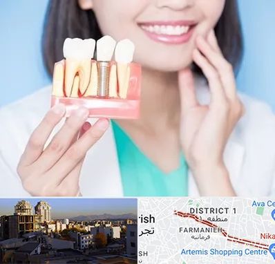 متخصص ایمپلنت در فرمانیه