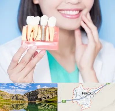 متخصص ایمپلنت در فیروزکوه