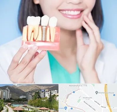 متخصص ایمپلنت در شهر زیبا