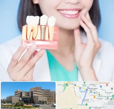 متخصص ایمپلنت در صیاد شیرازی مشهد