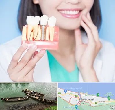 متخصص ایمپلنت در بندر انزلی
