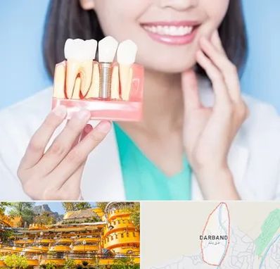 متخصص ایمپلنت در دربند