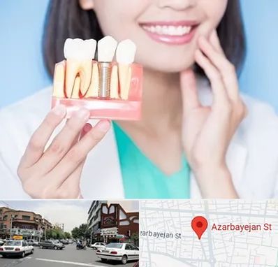 متخصص ایمپلنت در خیابان آذربایجان