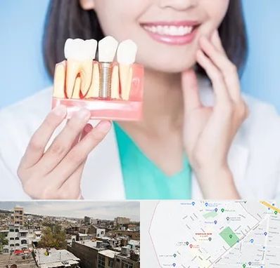 متخصص ایمپلنت در شمیران نو