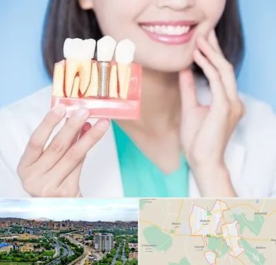 متخصص ایمپلنت در شهریار