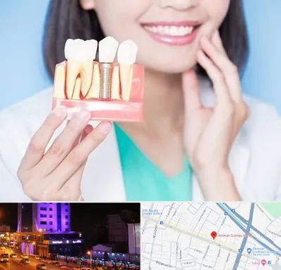 متخصص ایمپلنت در آبرسان تبریز