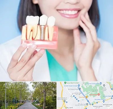 متخصص ایمپلنت در قدوسی غربی شیراز