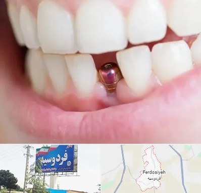 ایمپلنت اقساطی در فردوسیه شهریار