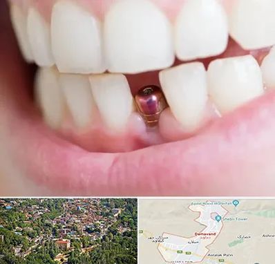 ایمپلنت اقساطی در دماوند