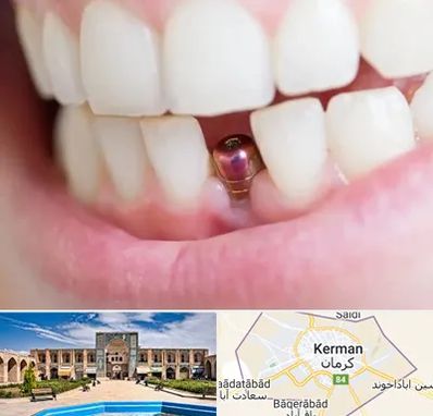 ایمپلنت اقساطی در کرمان